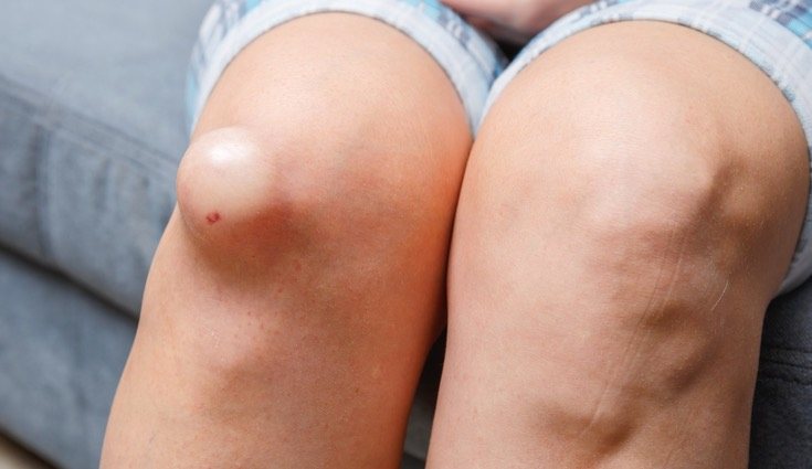 Provoca la aparición de bultos en la parte exterior de la rodilla