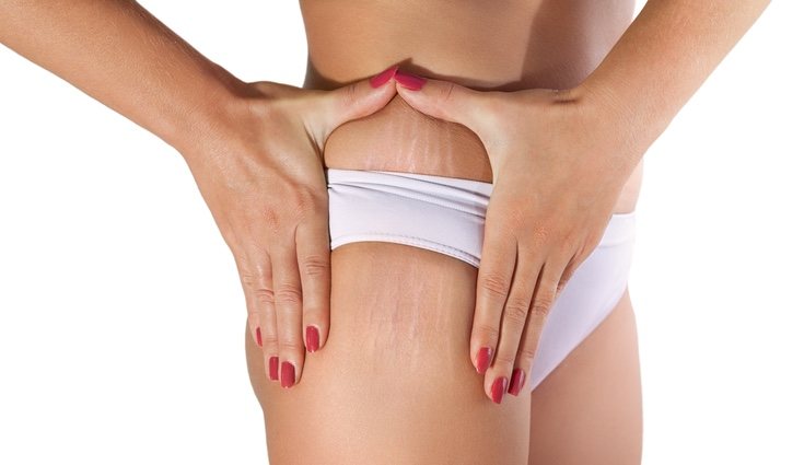 Es normal que salgan estrías durante el embarazo 