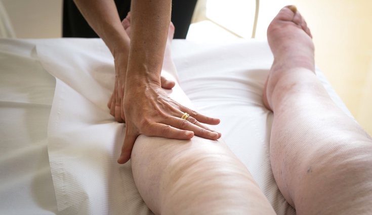 La retención de líquidos provoca edemas en diferentes partes del cuerpo