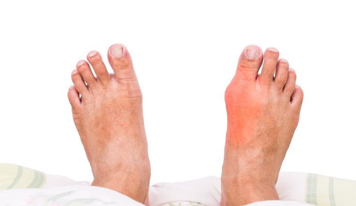 La gota produce el hinchazón de algunas extremidades del cuerpo como son los pies